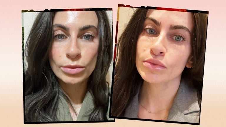 Lippenstraffung (Liplift)