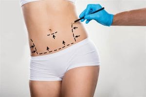 karin germe ameliyati Abdominal -Dehnungsoperation: Überraschender Weg, um Ihren Traumkörper zu bekommen