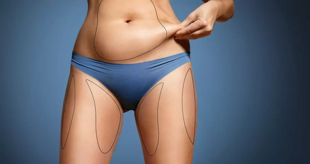 liposuction ile daha ince bir siluet A Slimmer Silhouette with Liposuction